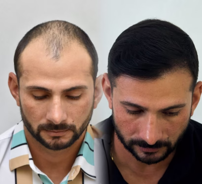 Resultado antes y después 5